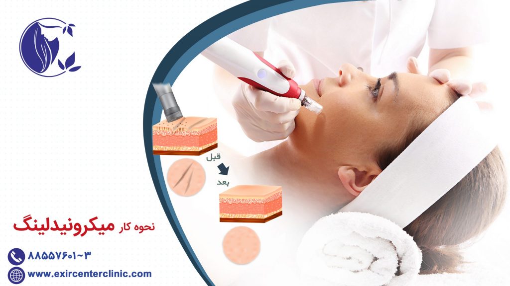 نحوه کار میکرونیدلینگ