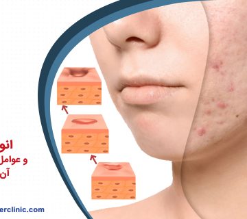 انواع اسکار و عوامل به وجود آمدن آن چیست؟