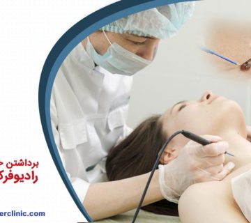 برداشتن خال با روش رادیوفرکانسی یا RF خال برداری با RF