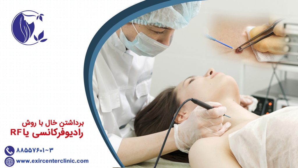 برداشتن خال با روش رادیوفرکانسی یا RF خال برداری با RF