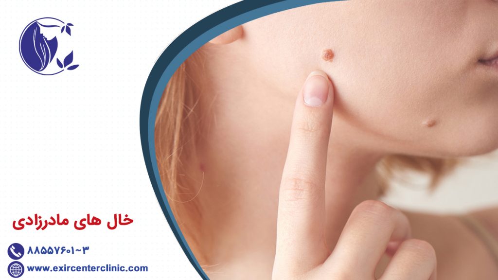 خال های مادرزادی