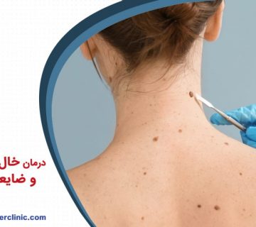 درمان خال های گوشتی و ضایعات پوستی