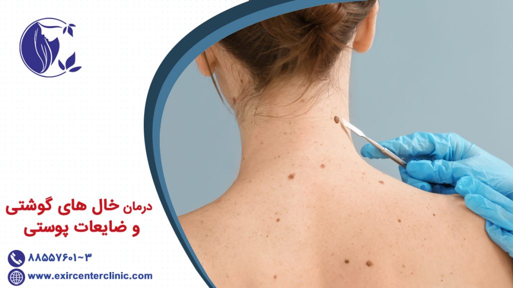 درمان خال های گوشتی و ضایعات پوستی