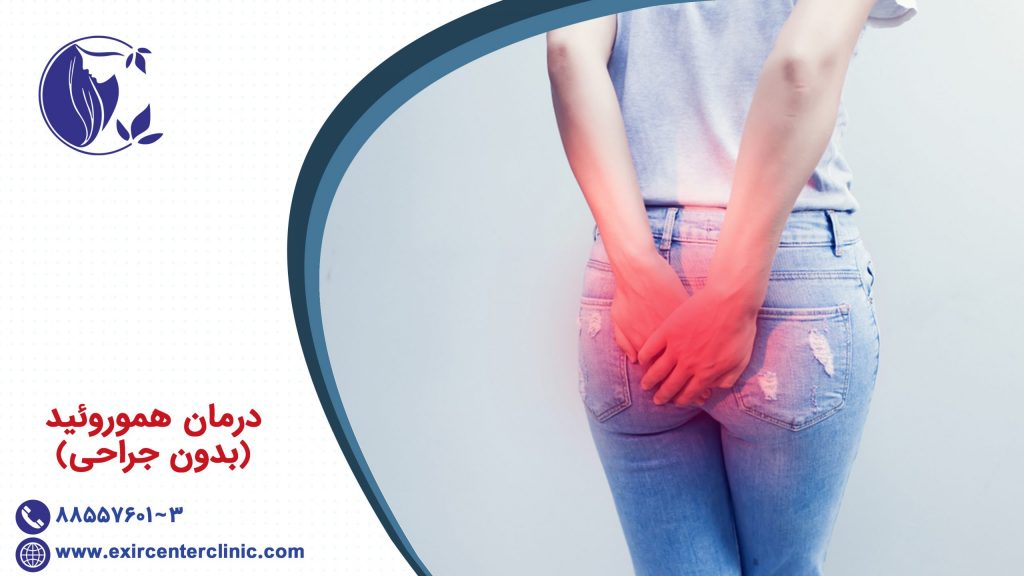 درمان هموروئید بدون جراحی