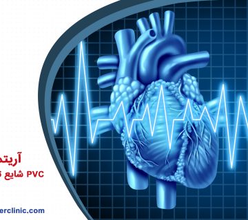 آریتمی قلب PVC شایع ترین آریتمی قلبی