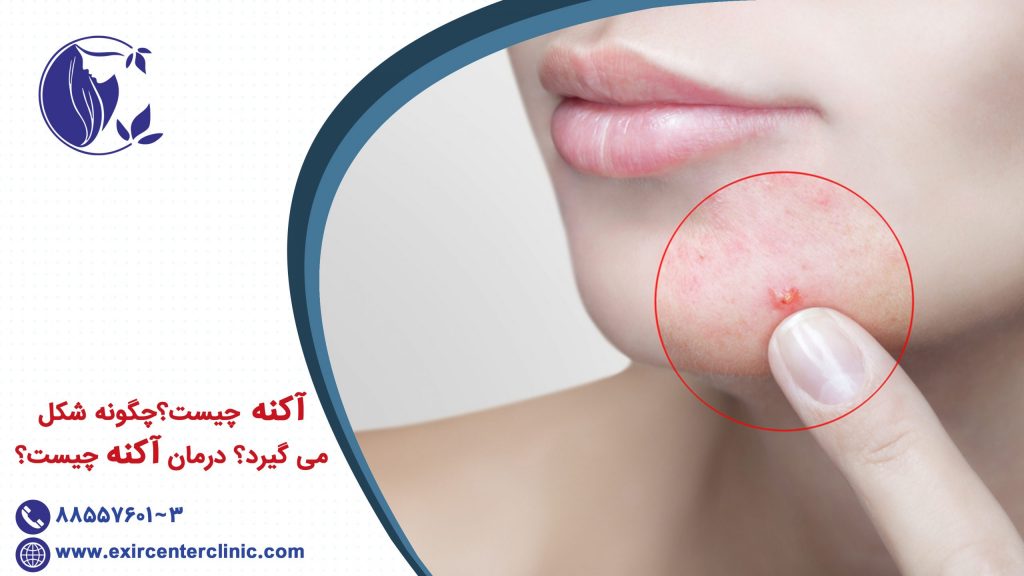 آکنه چیست؟ چگونه شکل می گیرد؟درمان آکنه چیست؟