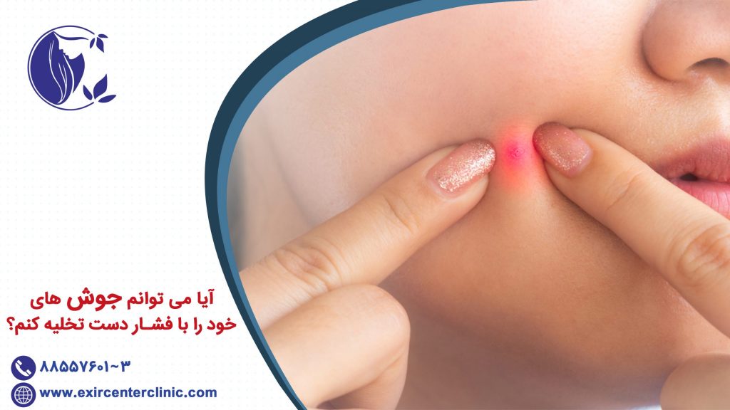 آیا می توانم جوش های