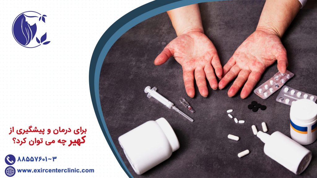 برای درمان و پیشگیری از کهیر چه می توان کرد؟