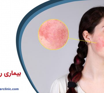 بیماری روزاسه چیست؟