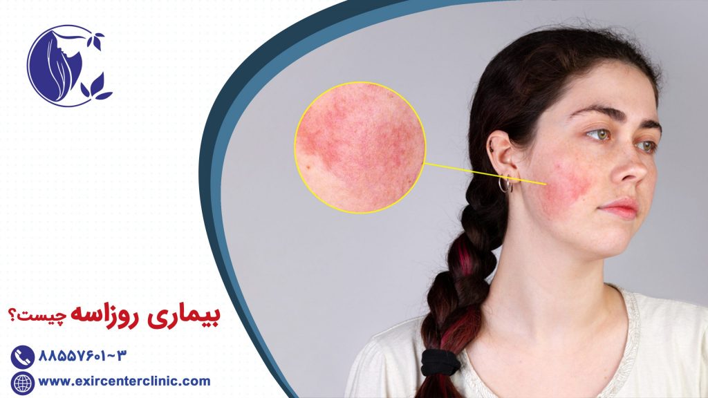 بیماری روزاسه چیست؟