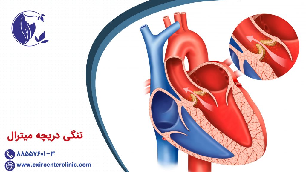 تنگی دریچه میترال