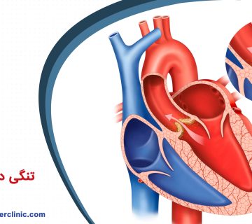 تنگی دریچه میترال