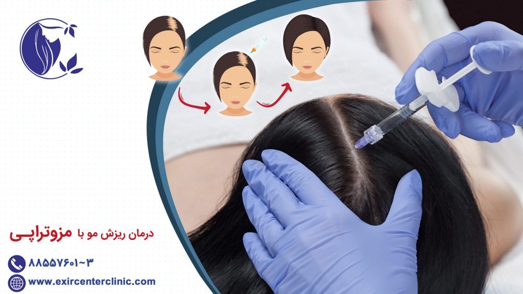 درمان ریزش مو با مزوتراپی