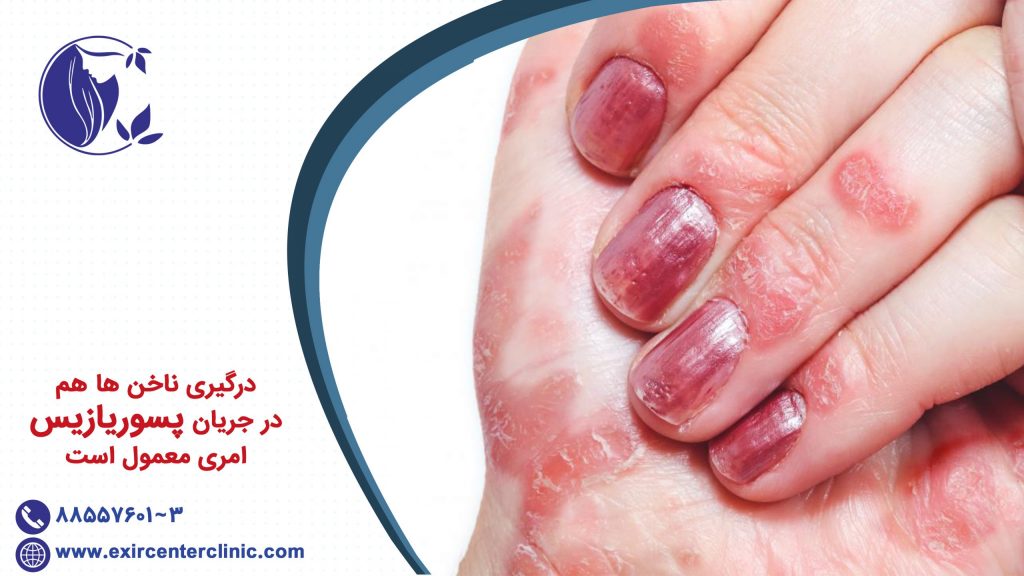 درگیری ناخن ها هم در جریان پسوریازیس امری معمول است.