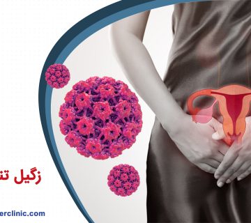 زگیل تناسلی