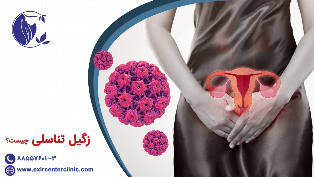 زگیل تناسلی