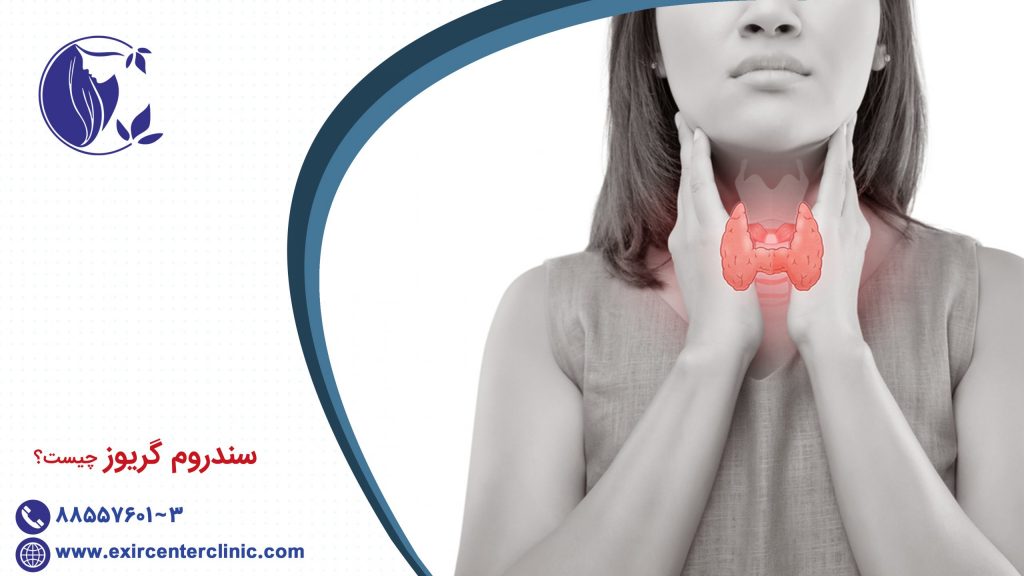 سندروم گریوز چیست؟