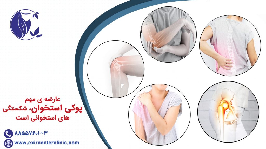 عارضه ی مهم پوکی استخوان، شکستگی های استخوانی است.