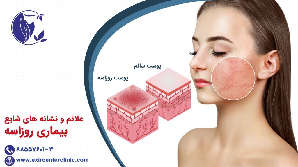 علائم و نشانه های شایع بیماری روزاسه