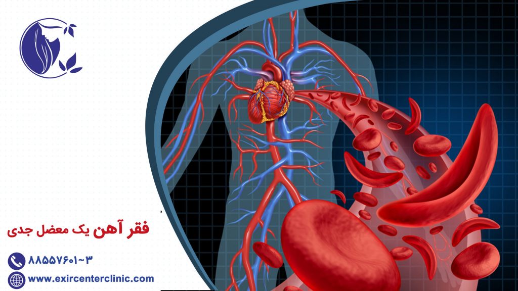 فقر آهن یک معضل جدی