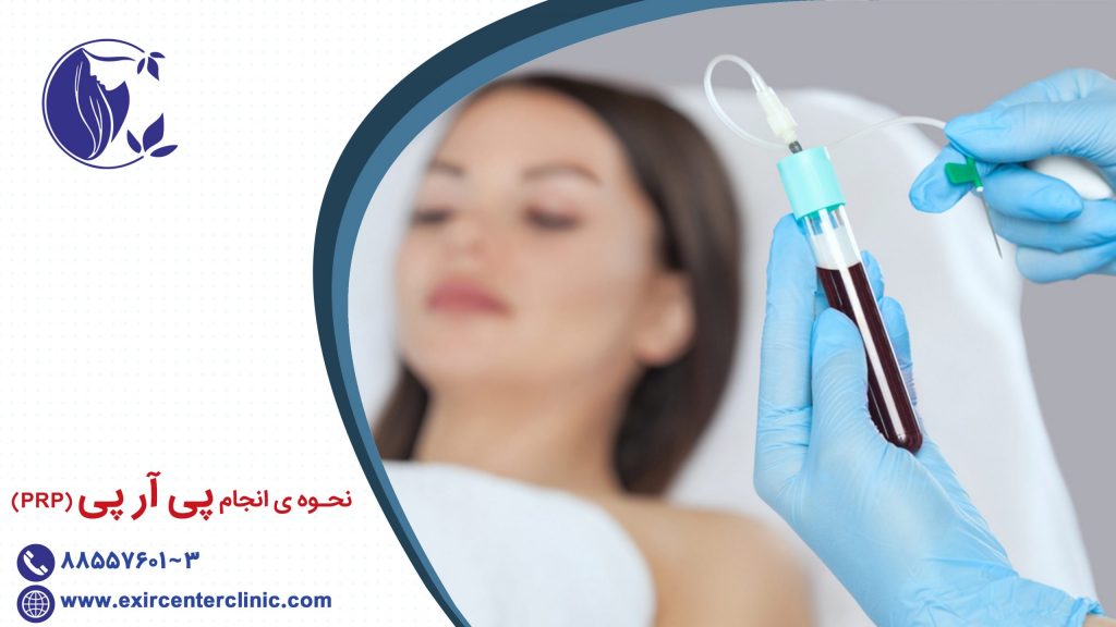 نحوه انجام پی آر پی (PRP)