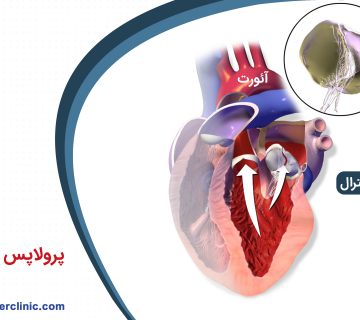 پرولاپس دریچه میترال