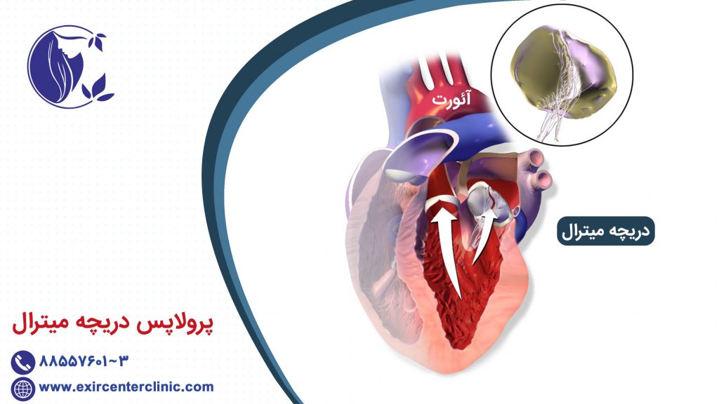 پرولاپس دریچه میترال