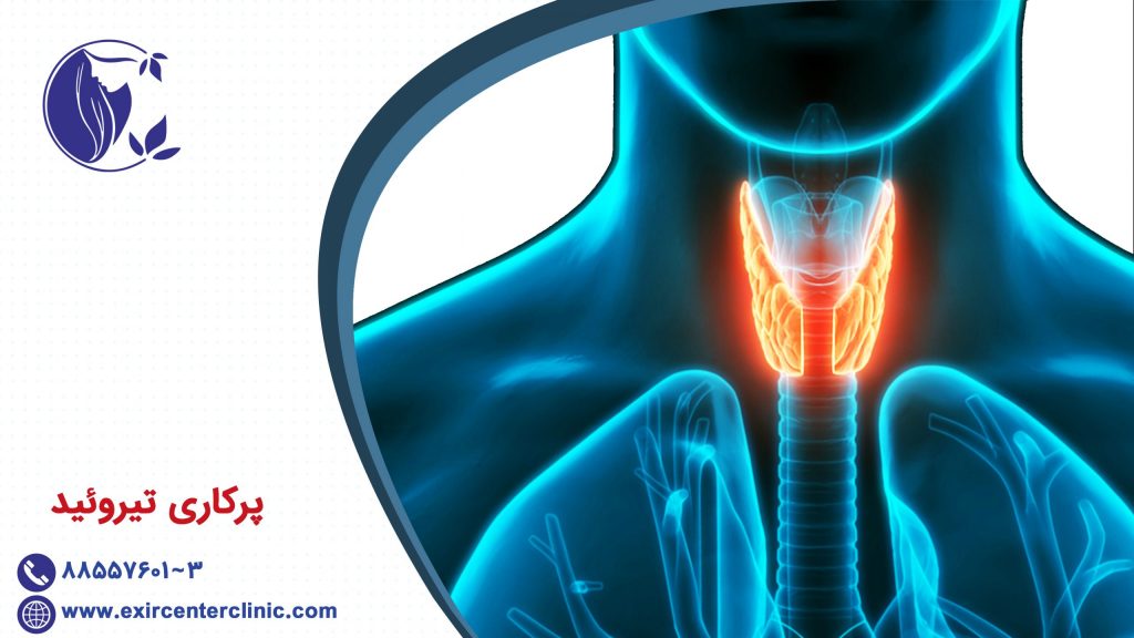 پرکاری تیروئید