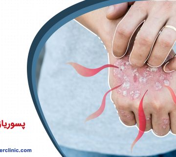 پسوریازیس چیست؟