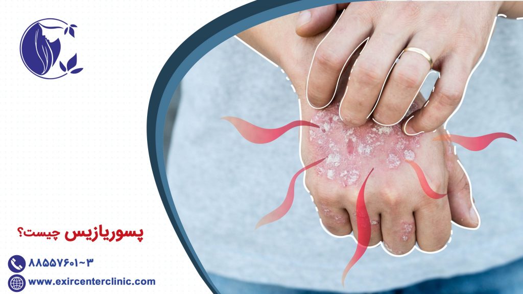 پسوریازیس چیست؟