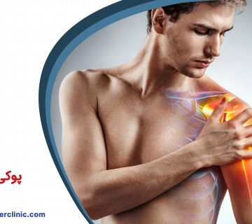 پوکی استخوان