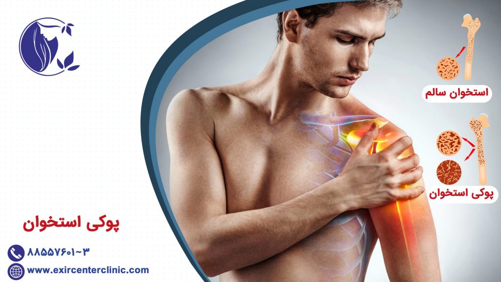 پوکی استخوان