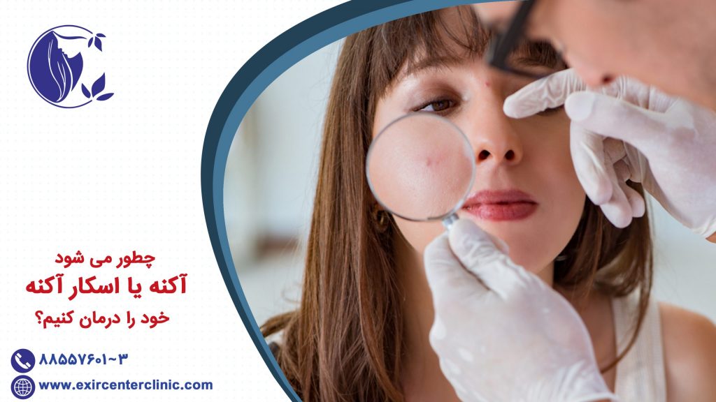 چطور می شود آکنه یا اسکار آکنه خود را درمان کنیم؟