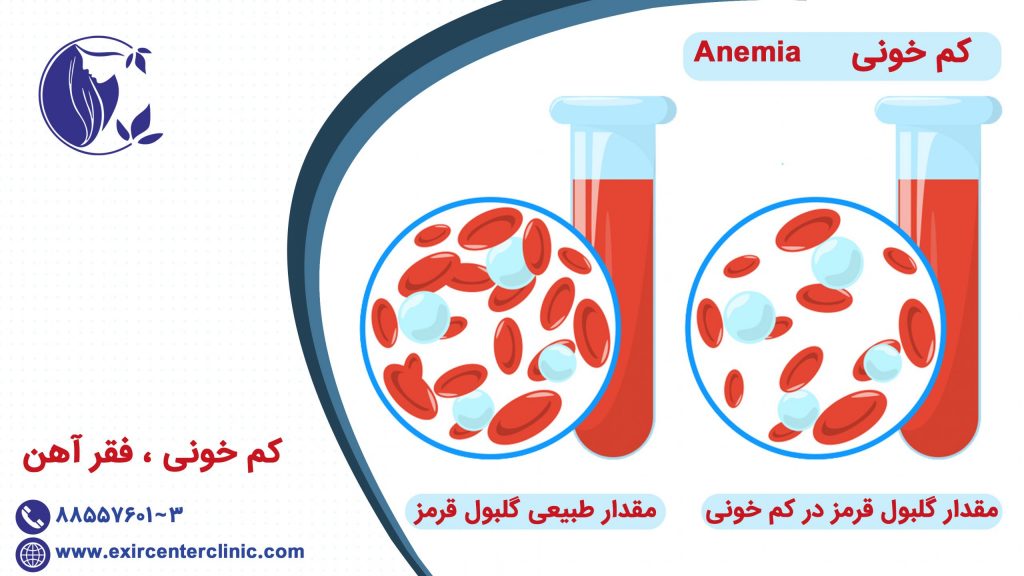 کم خونی فقر آهن