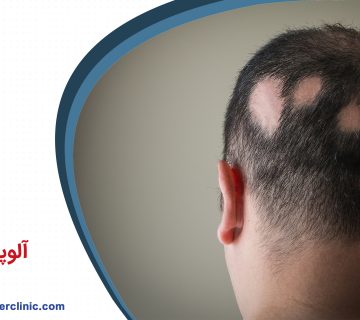 آلوپسیا چیست؟