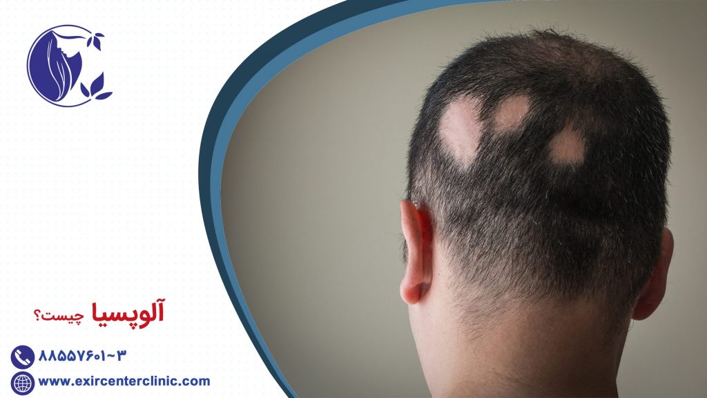 آلوپسیا چیست؟