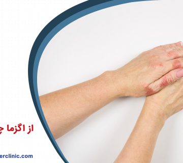 از اگزما چه می دانید؟