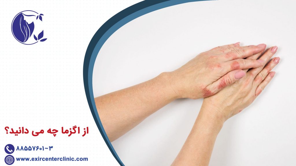 از اگزما چه می دانید؟