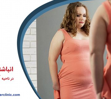 انباشتگی چربی در ناحیه کمر و باسن