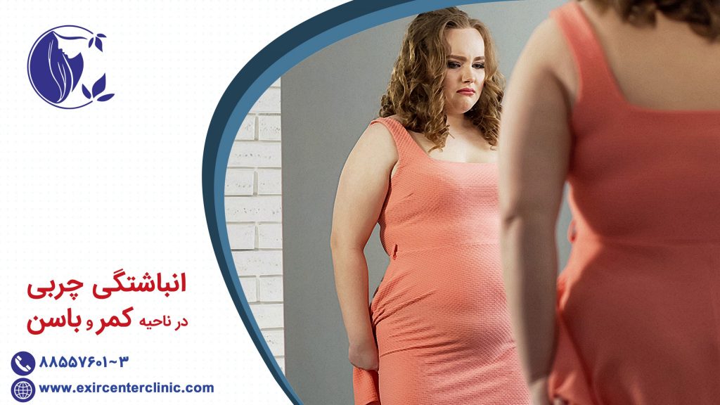 انباشتگی چربی در ناحیه کمر و باسن