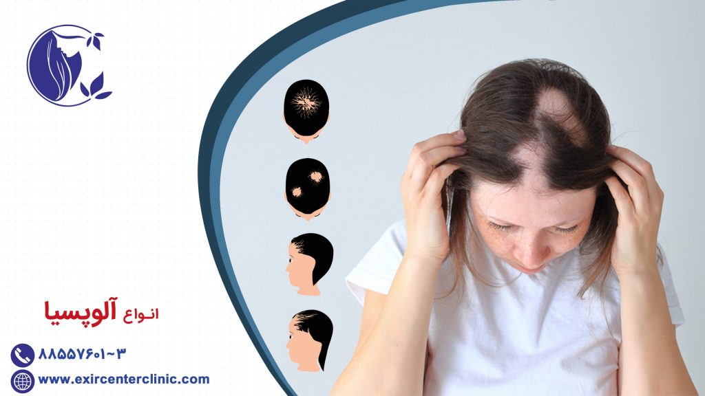 انواع آلوپسیا 