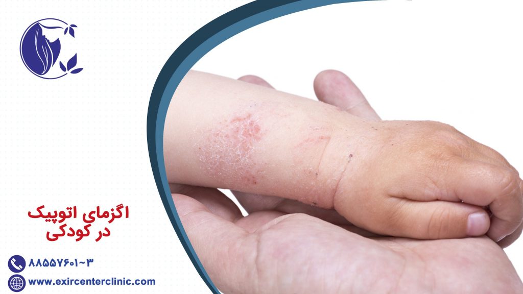 اگزماي اتوپيک در کودکی