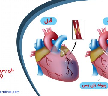 بای پس سرخرگ کرونری