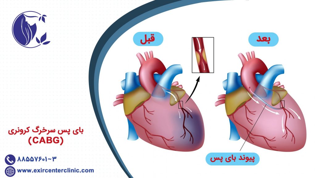 بای پس سرخرگ کرونری