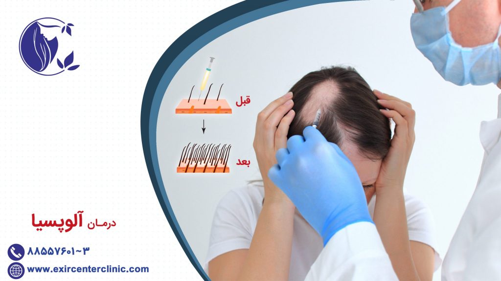 درمان آلوپسیا