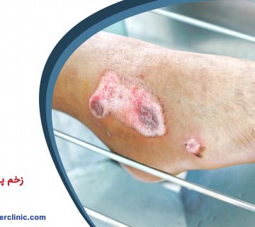 زخم پای دیابتی