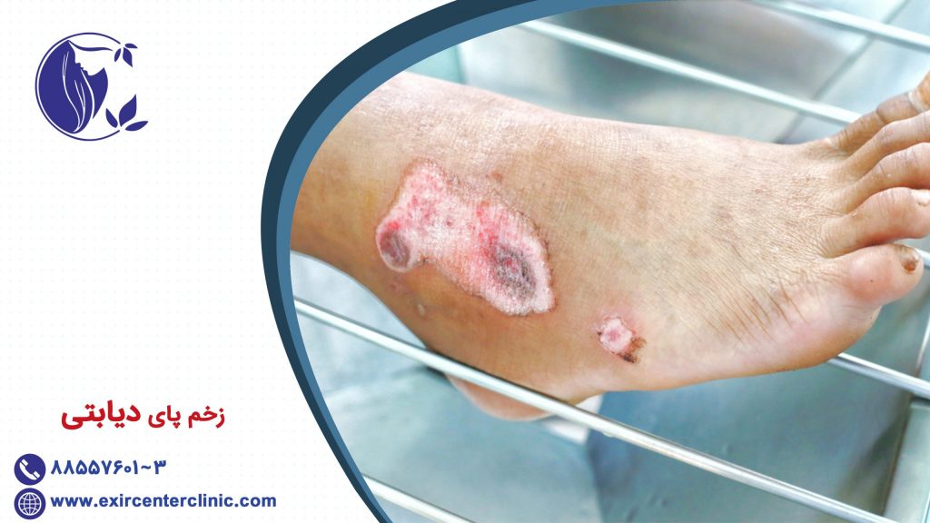 زخم پای دیابتی