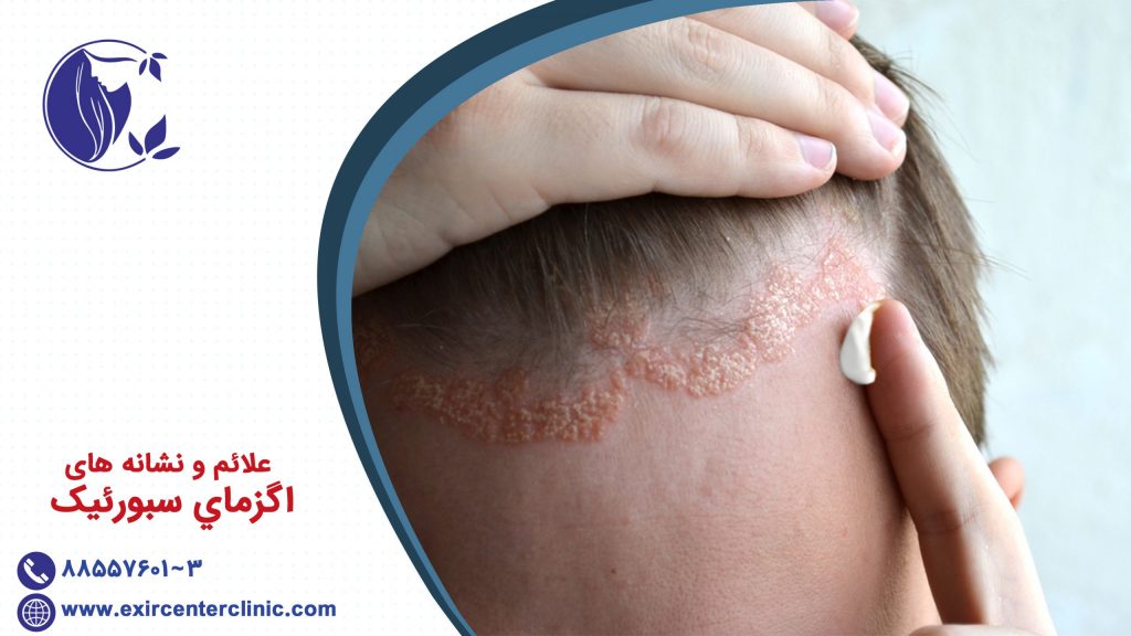 علائم و نشانه های اگزماي سبورئيک