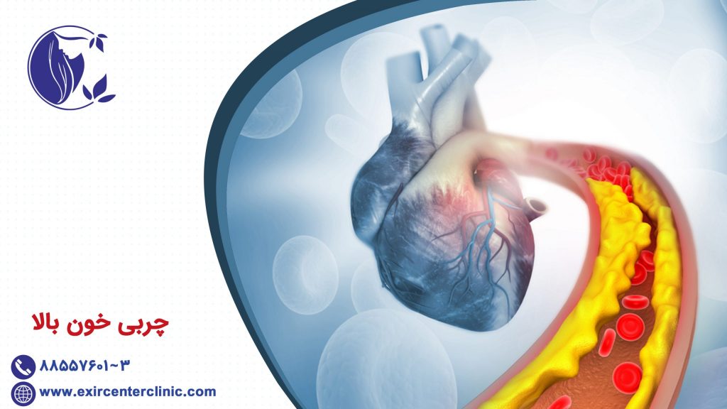 چربی خون بالا