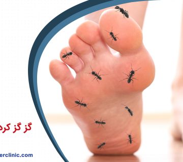 گز گز کردن دست و پا